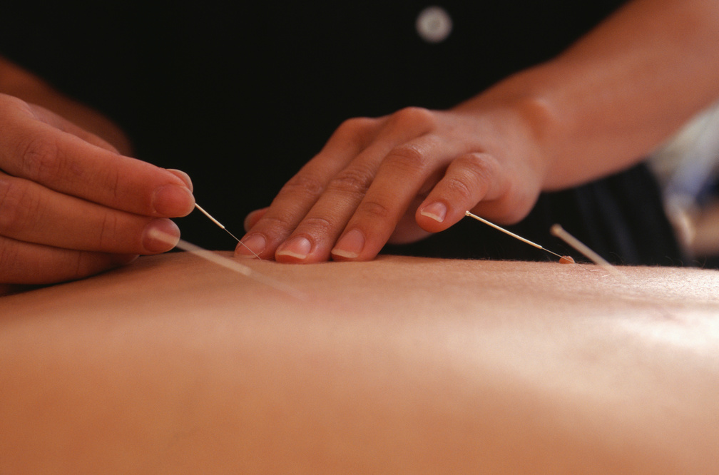 Person having acupuncture done to back, close-up