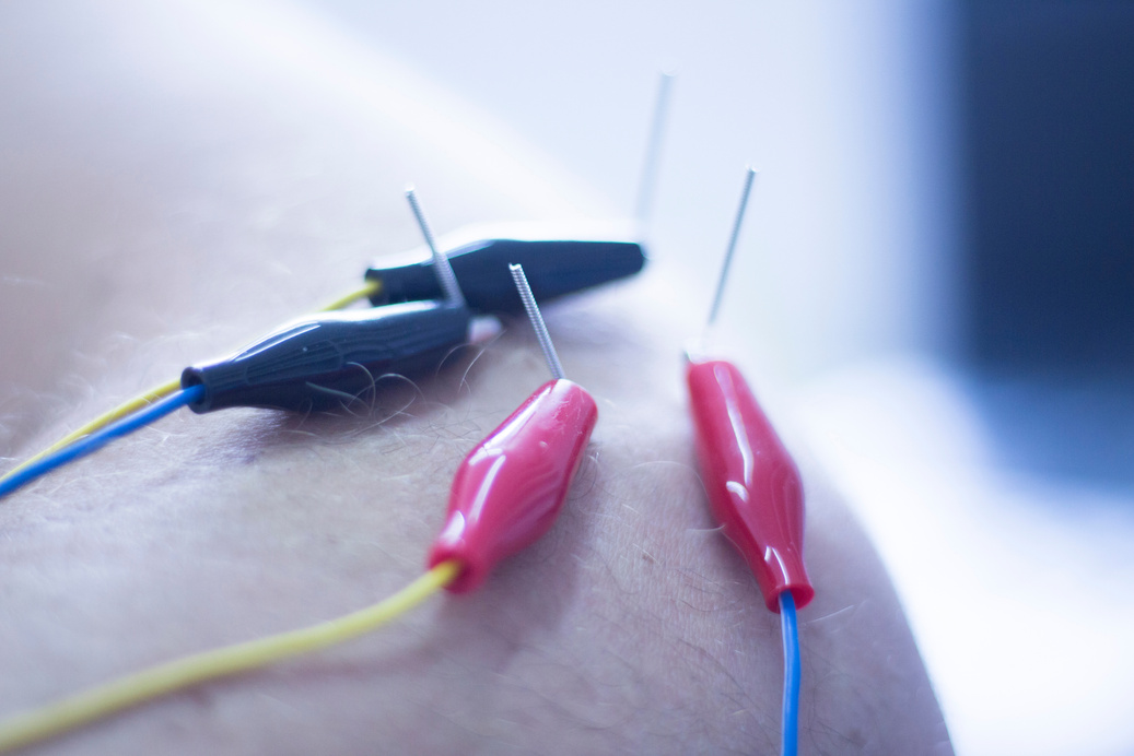 Electroacupunture Acupunture Needles