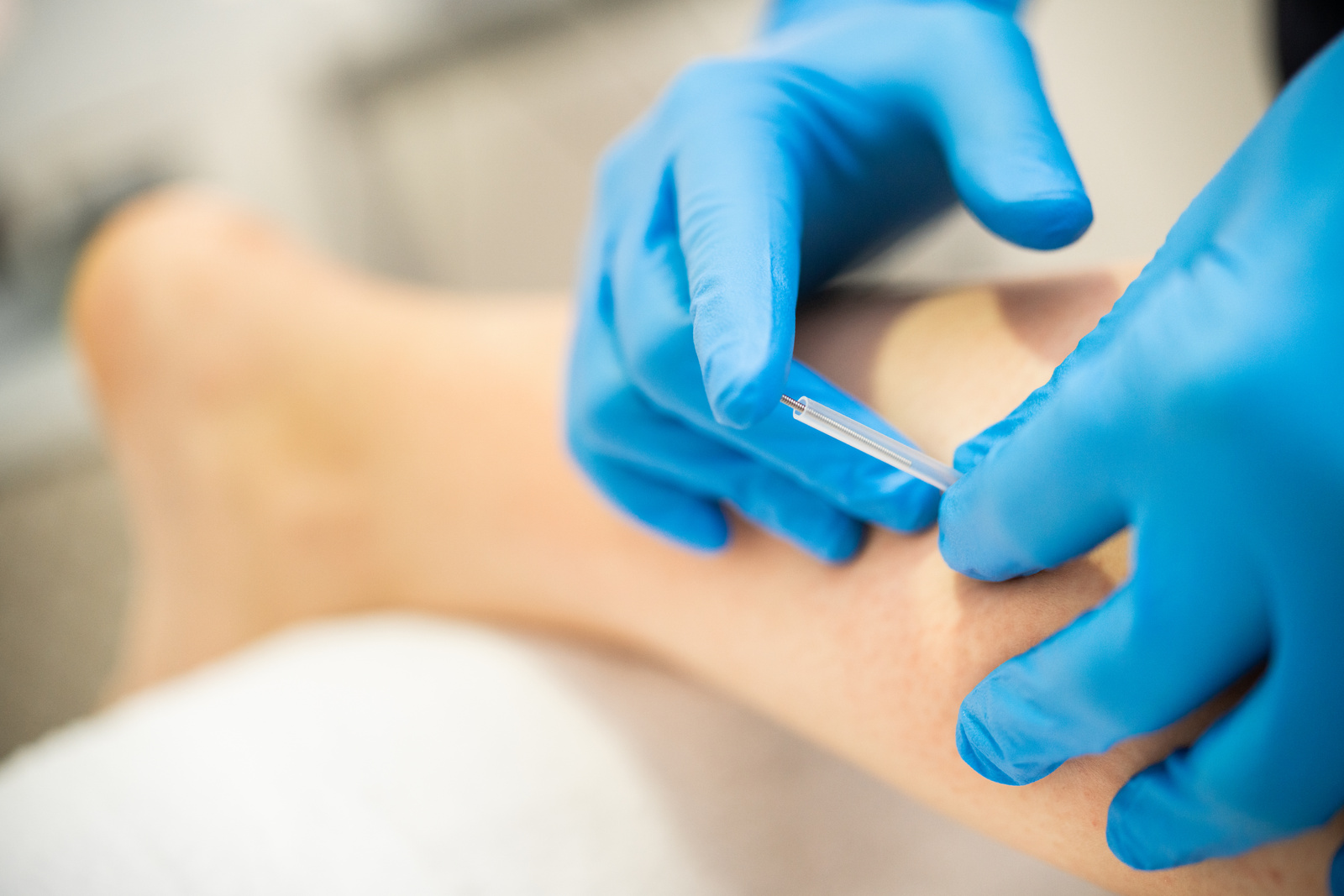 Physiotherapist Doing Dry Needling Treatment